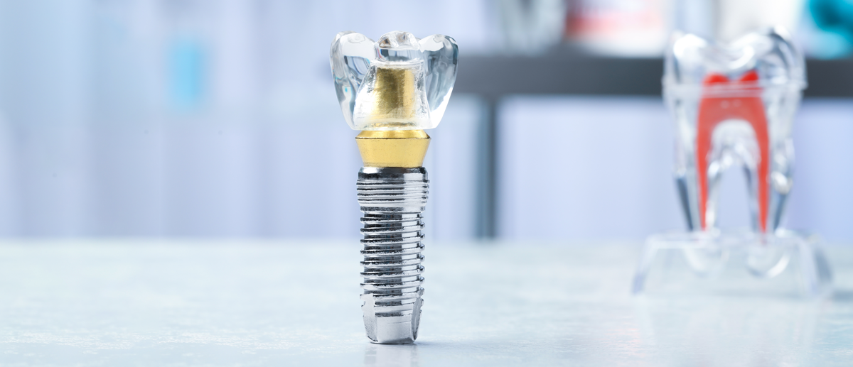 精度の高いインプラント治療